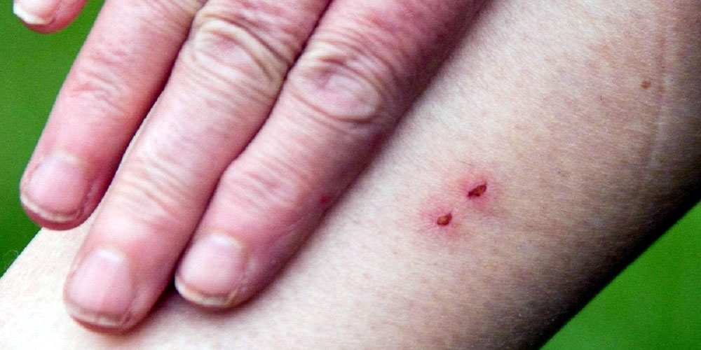 कञ्चनपुरमे सर्पदंशके बिरामी बह्रलै