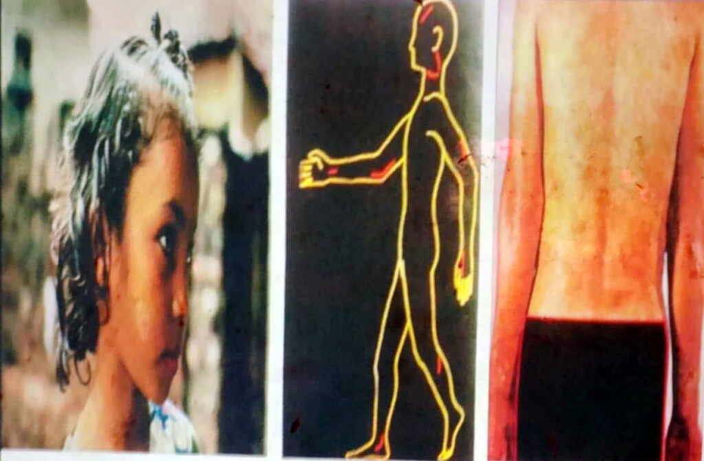 कैलारी–१ मनाउँमे विफेक रोज काल्ह छाला रोग सम्बन्धी चेकजाँच तथा राेग पहिचान शिविर हुइना